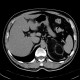 Myelolipoma, adrenal: CT - Computed tomography